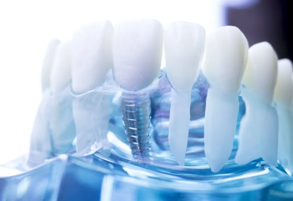 Zubni implanti
